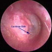 Middle Ear Valsalva with an Eardrum Perforation