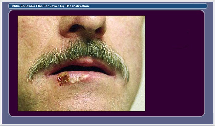 Slide 1. Preoperative Appearance