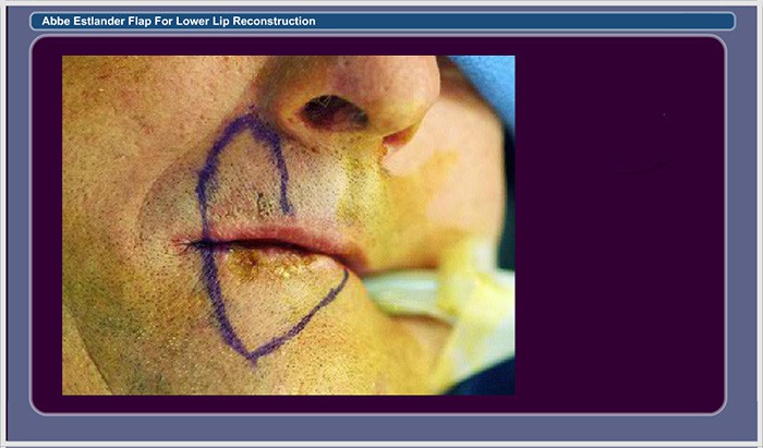 Slide 2. Lip Incisions Outlined