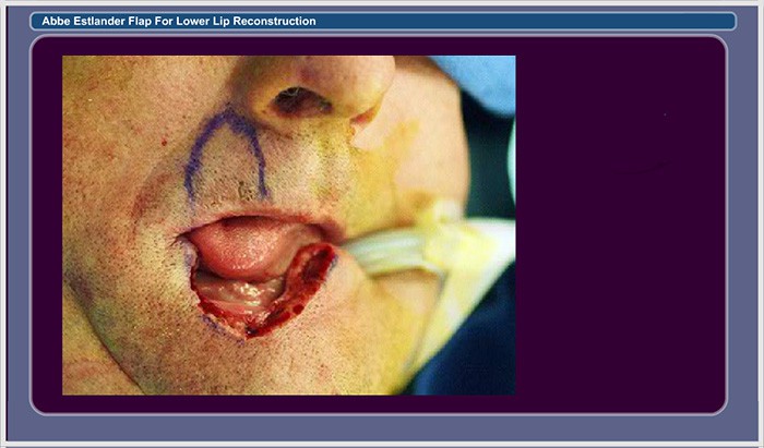 Slide 3. Cancer Resected