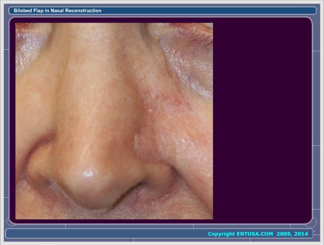 Slide 11. Postoperative Appearance of Nose