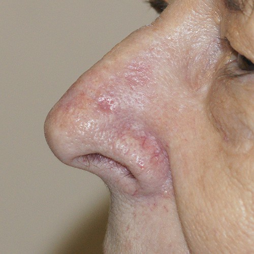 Slide 1.  Preoperative Appearance of Basal Cell Carcinoma of the Nose