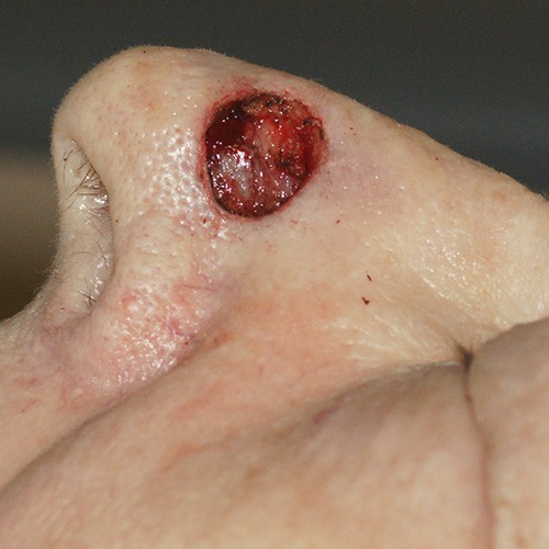 Slide 2.  Nasal Defect After Mohs Excision
