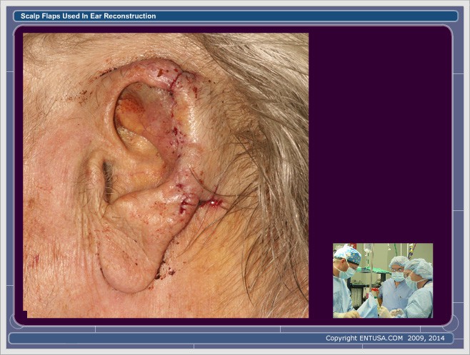 Slide 8. Ear Reconstruction - Post-Op Stage 1