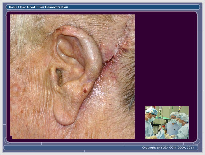 Slide 17. Ear Reconstruction - Post-Op Stage 2