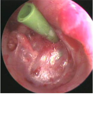 1.  Severe Atelectasis of the Eardrum - Post Op