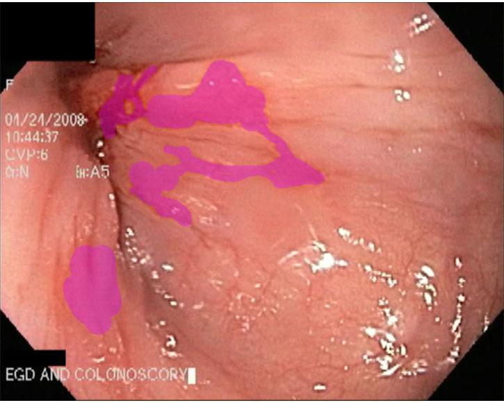 11.  Gastric Mucosa in the Lower Esophagus - Barrett's Esophagus