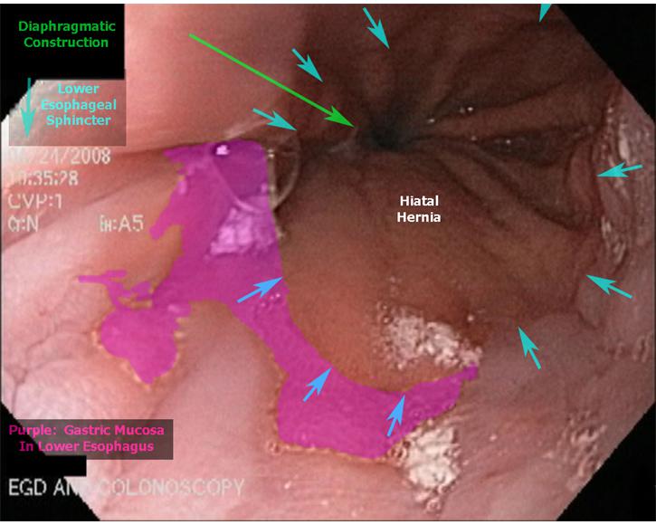 3.  Gastroesophageal Junction - Barrett's Esophagus