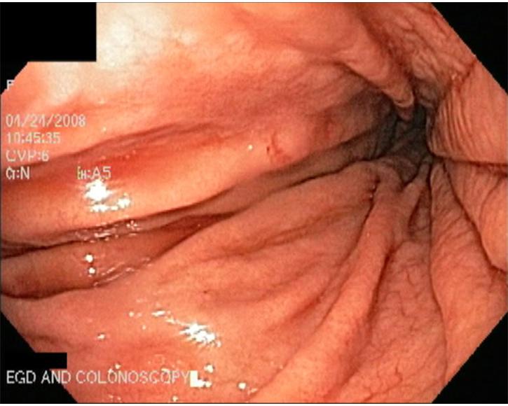 5.  Gastric (Stomach) Mucosa with Large Folds or Rugae