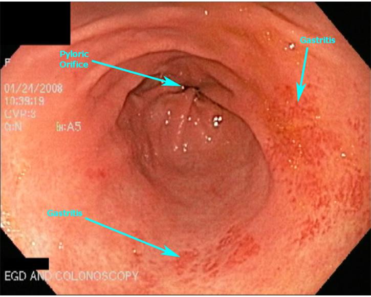 6.  Pyloric Antrum & Orifice - Note The Areas of Gastritis