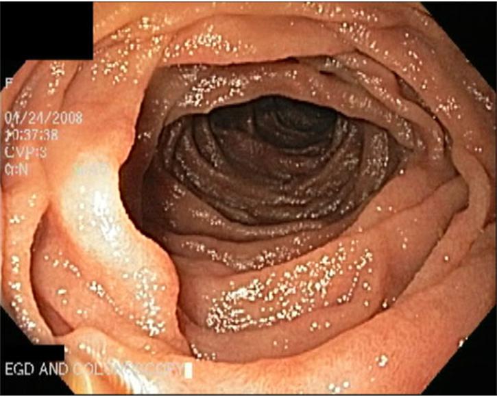7.  Gastroscopy is passed through the pyloric orifice.  Appearance of the Duodenum
