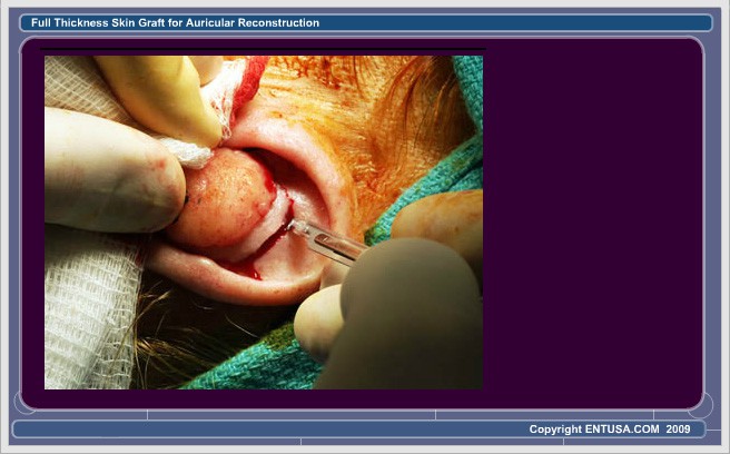 Slide 2. Skin and Cartilage Incision