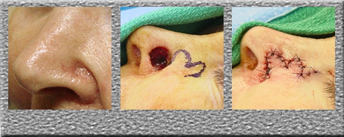 Nasal Bilobed Flap - Click Here to View Pictures