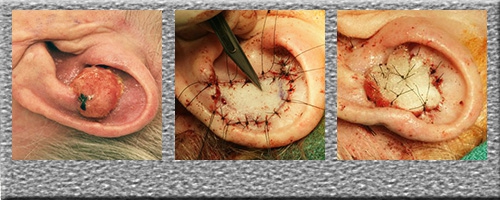 Full Thickness Skin Graft - Click Here to View Pictures