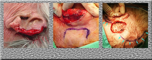 Ear Reconstruction - Scalp Flap - Click Here to View Pictures