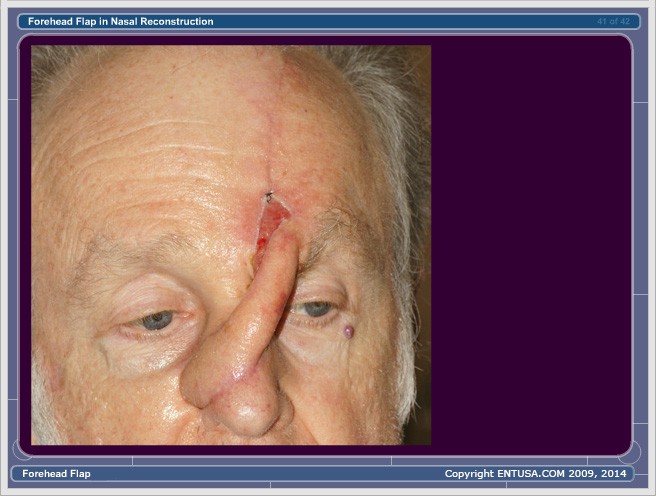 Slide 11. Forehead Flap - Stage 1