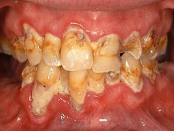 2. methamphetamine and dental caries