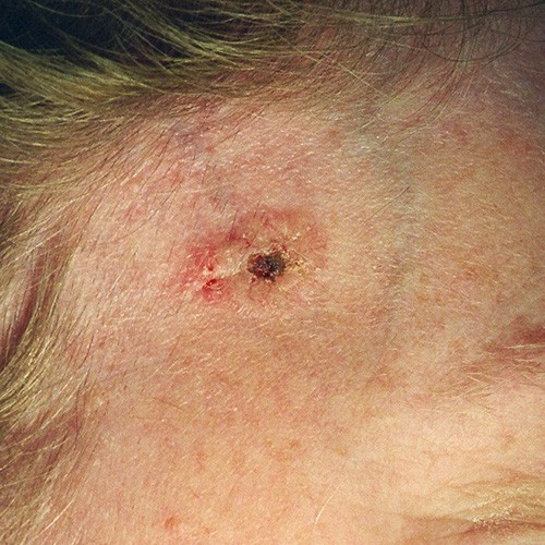 Slide 1. Basal Cell Carcinoma of the Right Temple