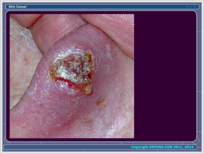 Slide 7.  Squamous Cell Carcinoma
