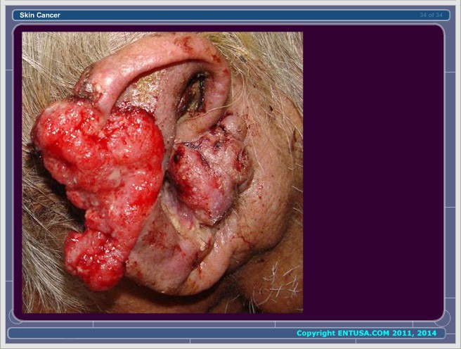 Slide 10.  Squamous Cell Carcinoma