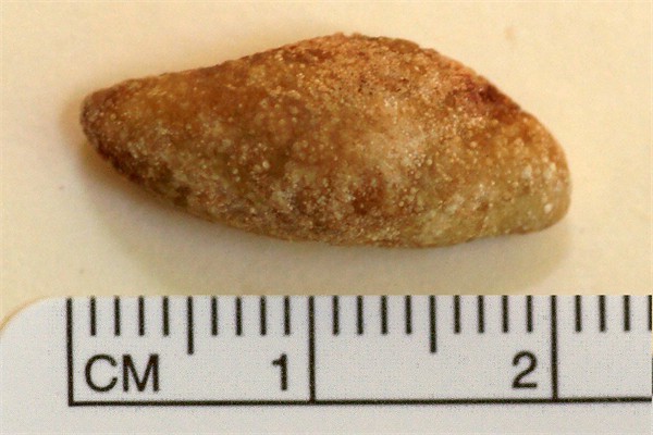 12.  Salivary Gland Stone (Megalith)