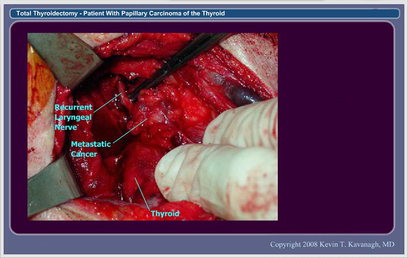 10.  Inferior Exposure of Recurrent Laryngeal Nerve