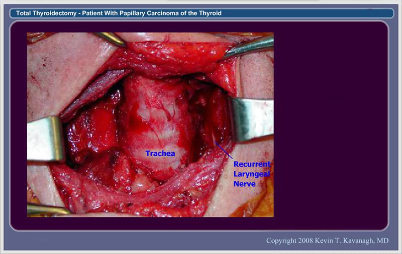 12.  Wound Appearance After Thyroid Removal