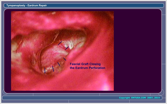 25.  Closing the Middle Ear