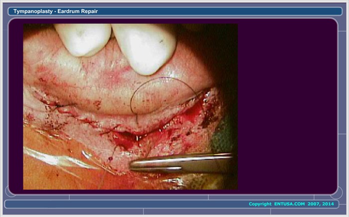 30.  Closing the Skin Incision
