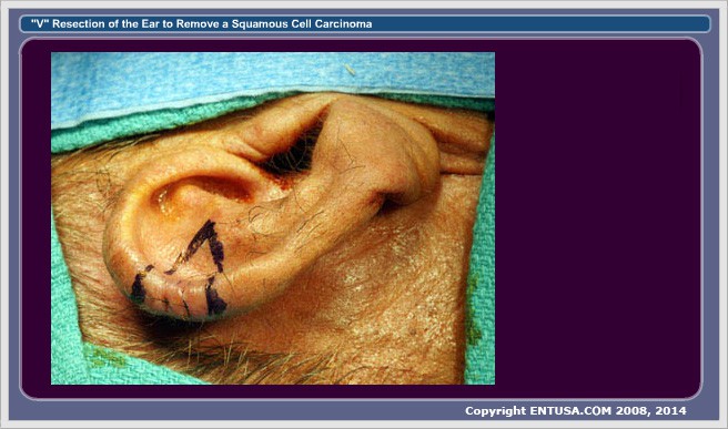 2. Ear Incision Outlined