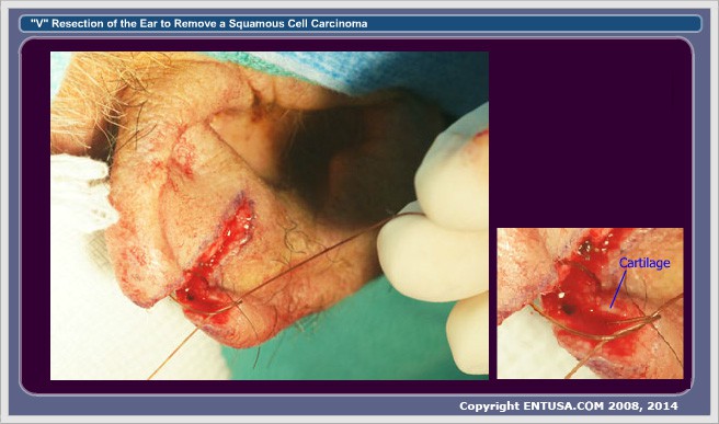 8. Cartilage Closed
