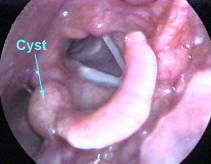 Larynx Cyst