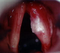 T1 Squamous Cell Carcinoma of the True Vocal Cords