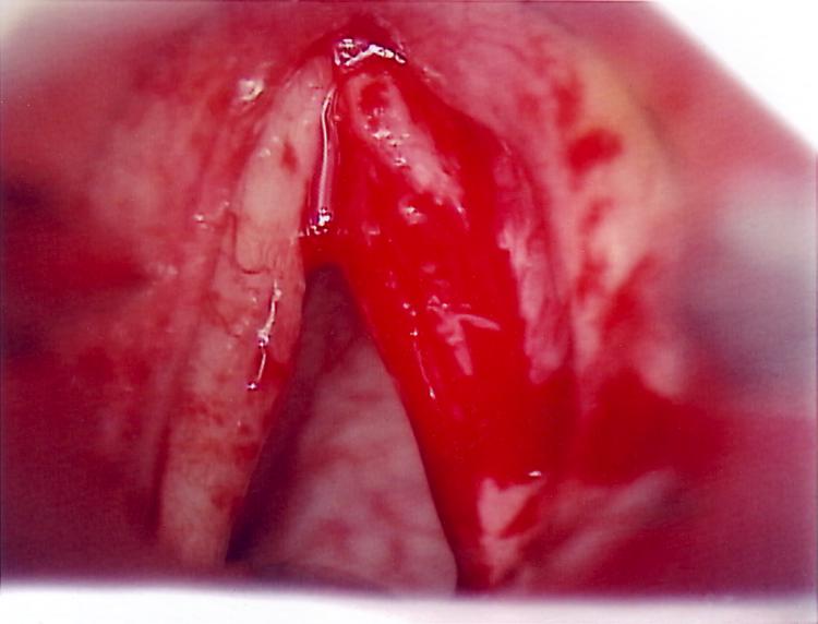 Appearance of a True Vocal Cord after Resection of a Squasmous Cell Carciinoma