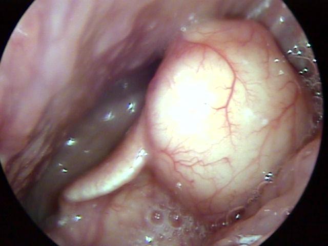 Large Cyst of the Epiglottis and Vallecula 