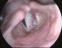 Congenital Anomaly of the Larynx