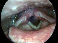 Bilateral  Vocal Cord Paralysis - Larynx