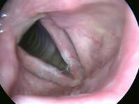 Appearance of Larynx After Removal of True Vocal Cord Polyps