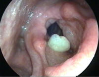 Large Right True Vocal Cord Polyp