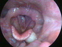 Bilateral Vocal Cord Polyps