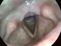 Vocal Cord Appearance After Giant Polyp Removal