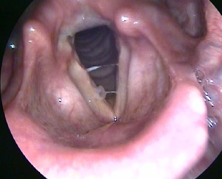 Small Vocal Cord Cyst on the Right True Vocal Cord