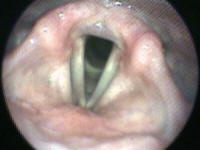 Normal Laryngeal Exam in a Patient with A Functional Voice Disorder - Conversion Reaction