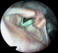 True Vocal Cord Paralysis - Larynx