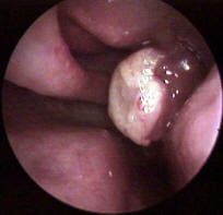 Inverted Papilloma of the Nasal Cavity