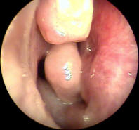 Picture of Nasal adenoma in left nasal cavity
