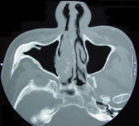 Axial CT Scan of Inverted Papilloma of the Nasal Cavity