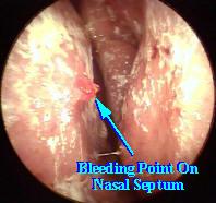 Epistaxis caused by a bleeding point on the nasal septum.