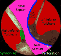 Nasal Septal Perforation Diagram