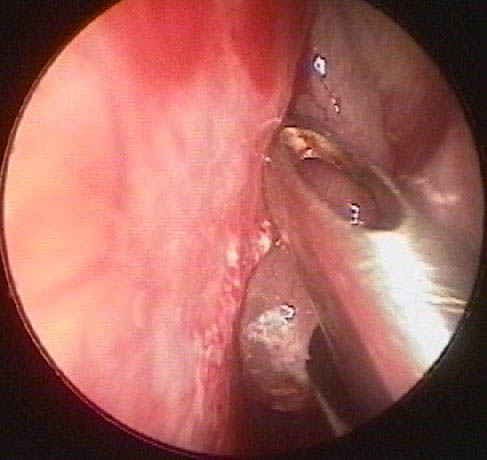 Biopsy of a Nasal Polyp